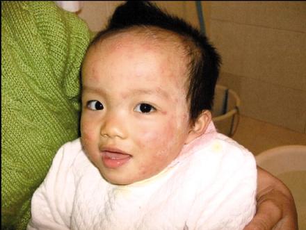 強生潤膚霜致幼兒過敏僅賠600稱產(chǎn)品合格(圖)