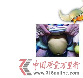 在“聲討金奇仕”的QQ群里,一位媽媽發的自己寶寶肋骨外翻的照片。 在“聲討金奇仕”的QQ群里,一位媽媽發的自己寶寶肋骨外翻的照片。