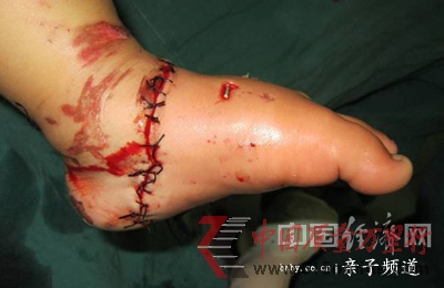 電瓶車咬斷女童左腳醫(yī)生呼吁強制安裝防護網(wǎng)(圖)